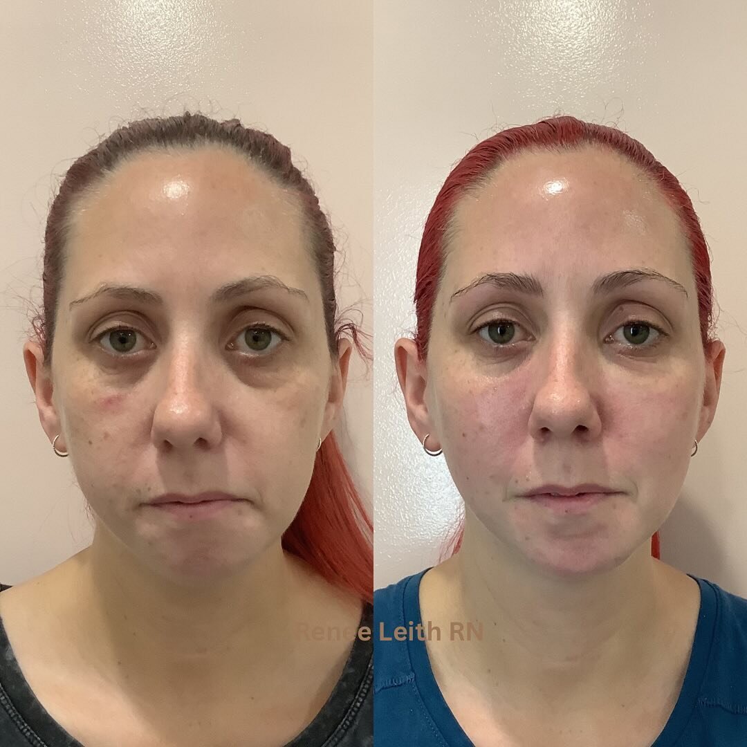 Volumization to the upper face. Tear Trough, Mid face, Lateral cheeks and Pre auricular. 

Due to having jaw reconstruction and plates insitu many years ago, I am unable to elongate, balance and give structure to the lower face. However I have used m