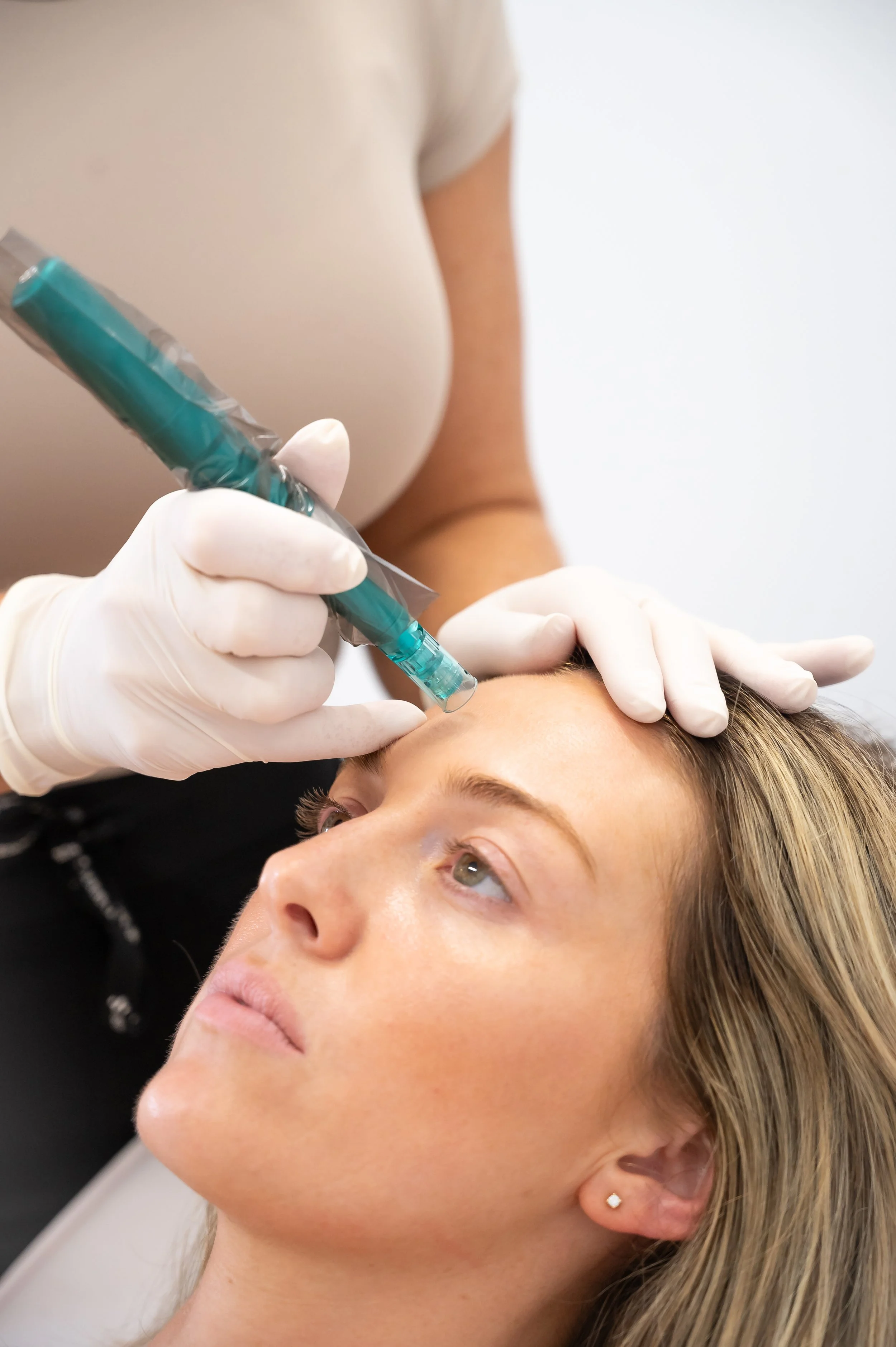 What to Know About Skin Needling Recovery Time
