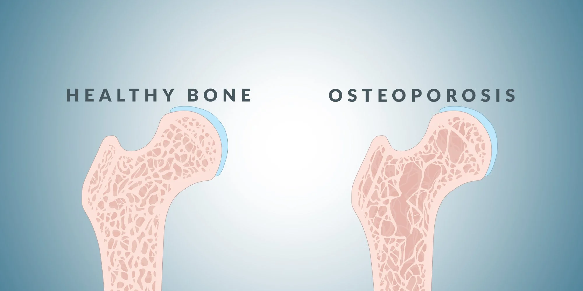 Osteoporosis-treatment-horseshoe-bay-health-west-vancouver