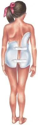 A generated image of a person wearing a back brace suited for scoliosis.