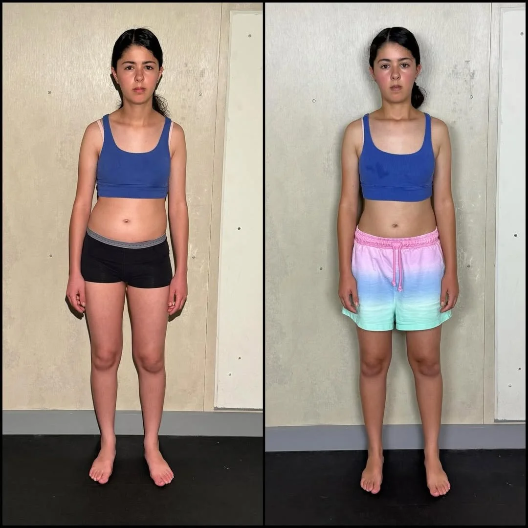 Side-by-side comparison of a young girl in athletic clothing, showing before and after photos, with noticeable postural changes including standing straighter, reduced lean and reduced hip hike