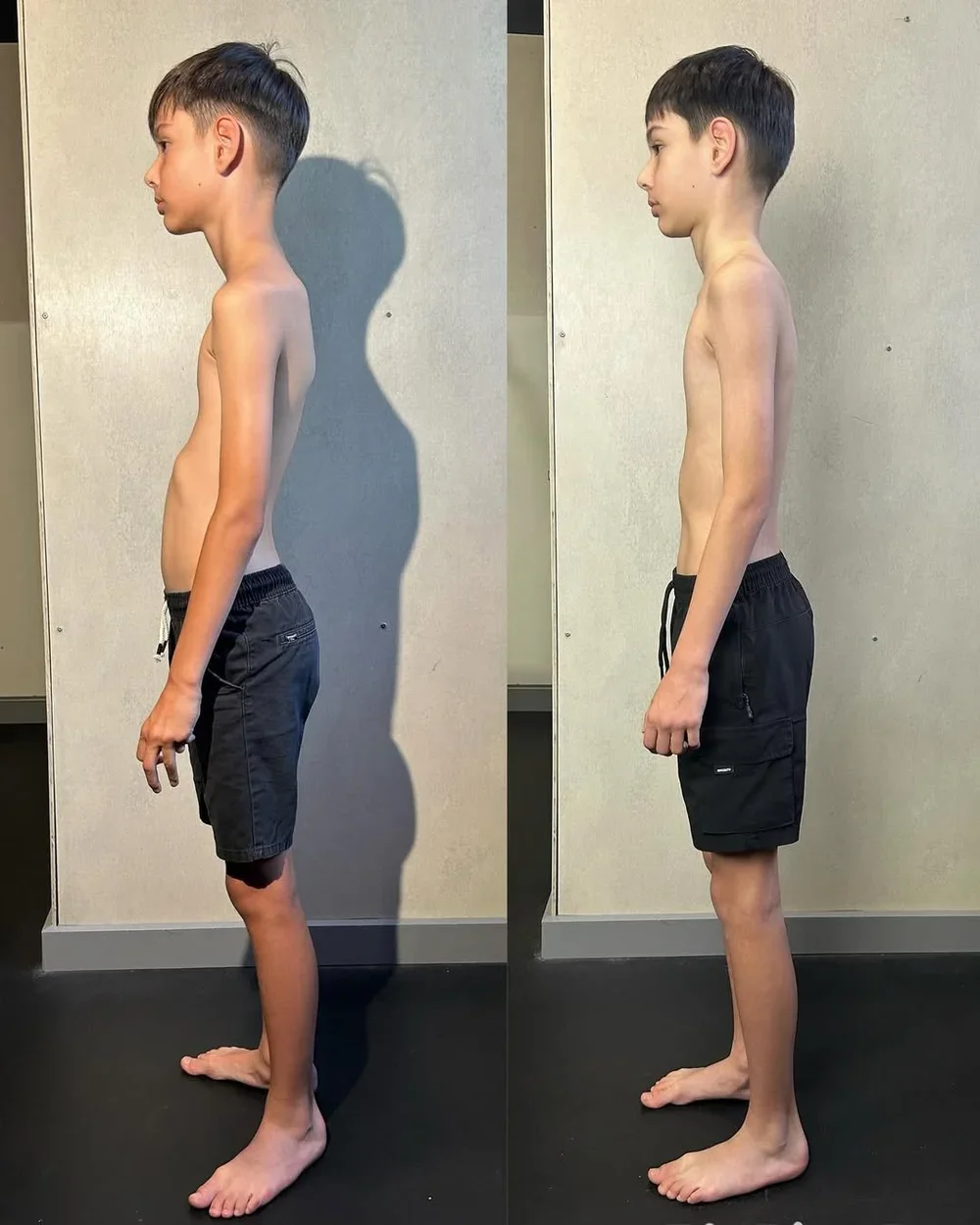 Comparison phot of a young boy with rounded shoulder, winged scapulas and hunched back on the left. On the right the boy stands straighter with better posture, aligned shoulder and straight back.