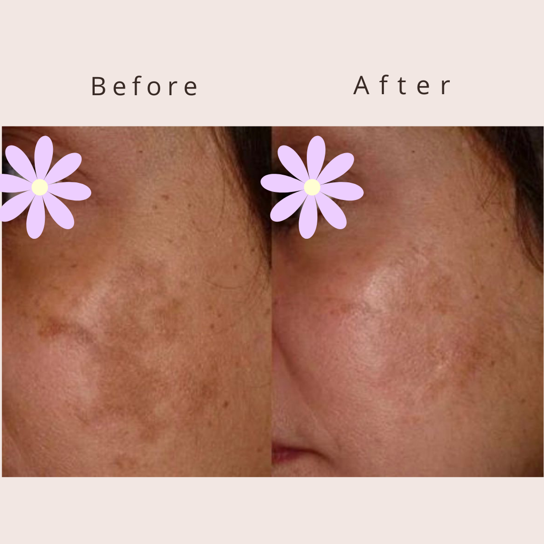 LIPOCAVITATION  (12).png