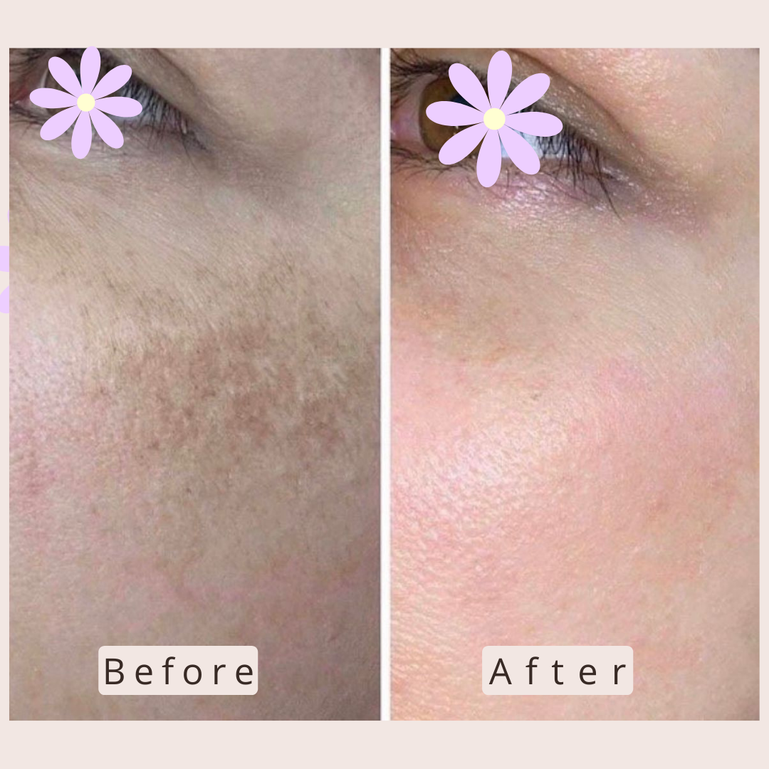 LIPOCAVITATION  (13).png