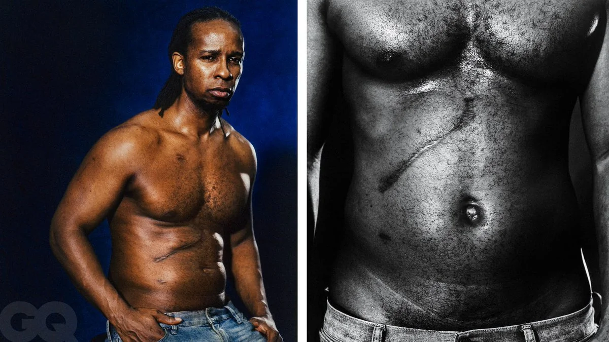 Scar Stories: The Toll of Colon Cancer