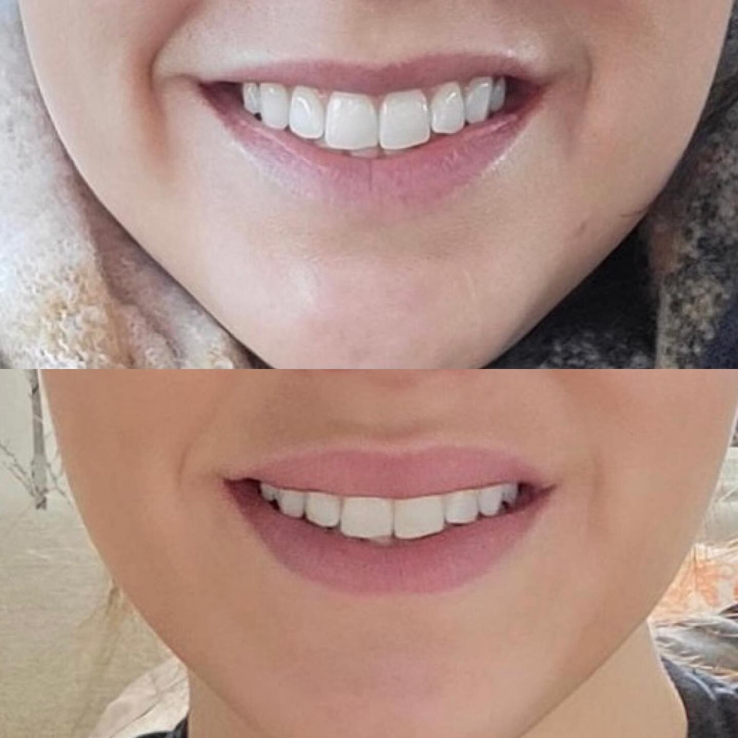 Lip flip before + after💋

A lip flip consists of placing botox along the lip to prevent the lip from curling in when you smile. Lip flips can help correct a gummy smile and give the appearance of a fuller lip. ✨