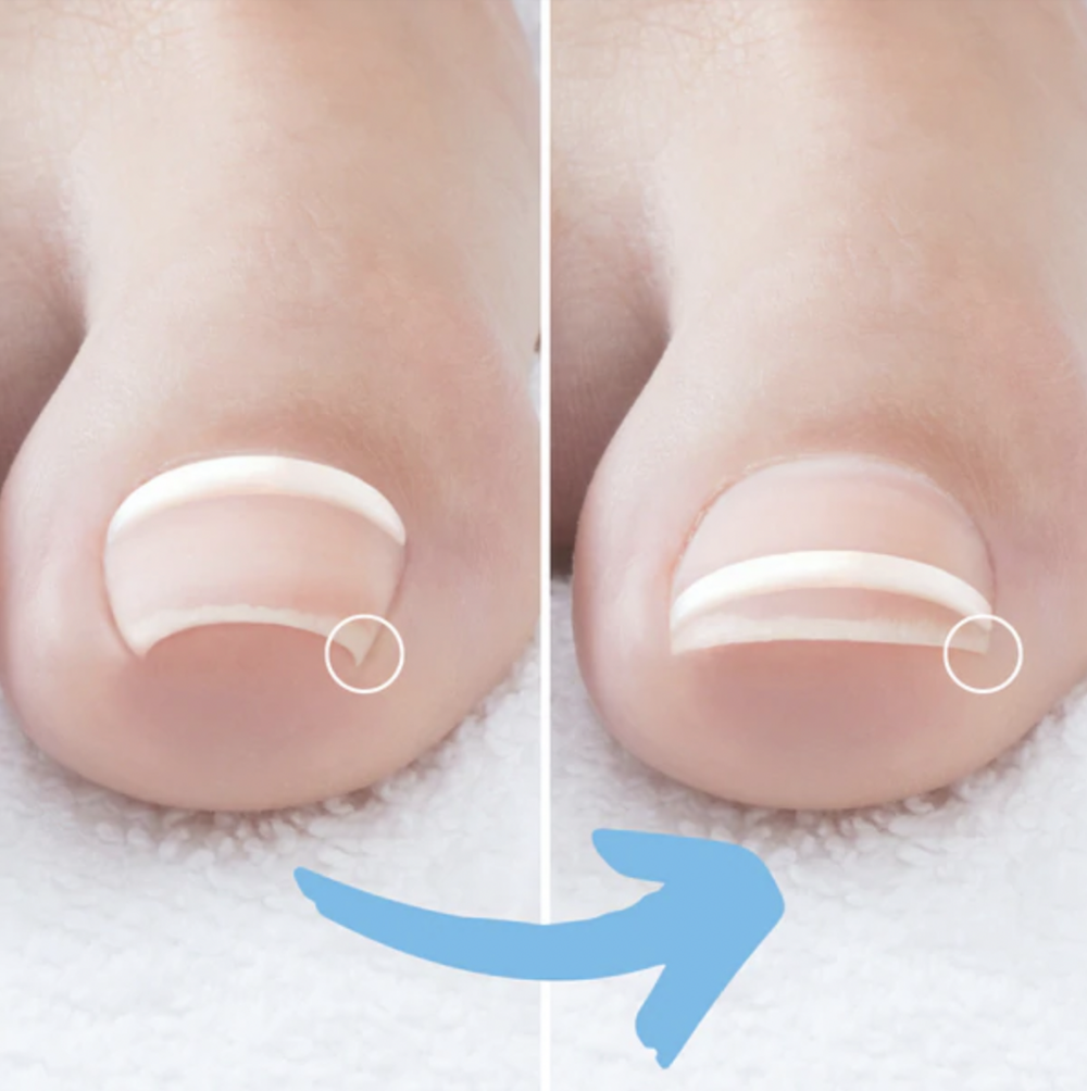 An ingrown toenail before and after Onyfix correction