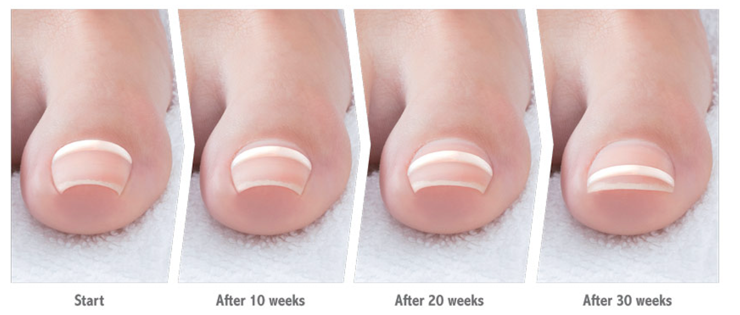 Illustration of an ingrown toenail flattening over time with Onyfix: start, after 10 weeks, after 20 weeks, and after 30 weeks