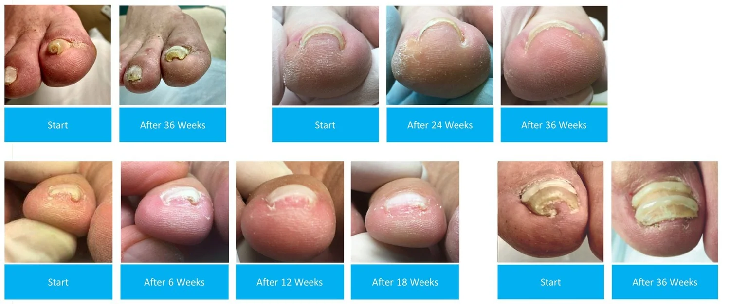 Four patient examples of ingrown toenails before Onyfix and at follow-up between 6 and 36 weeks, showing the nails growing flatter