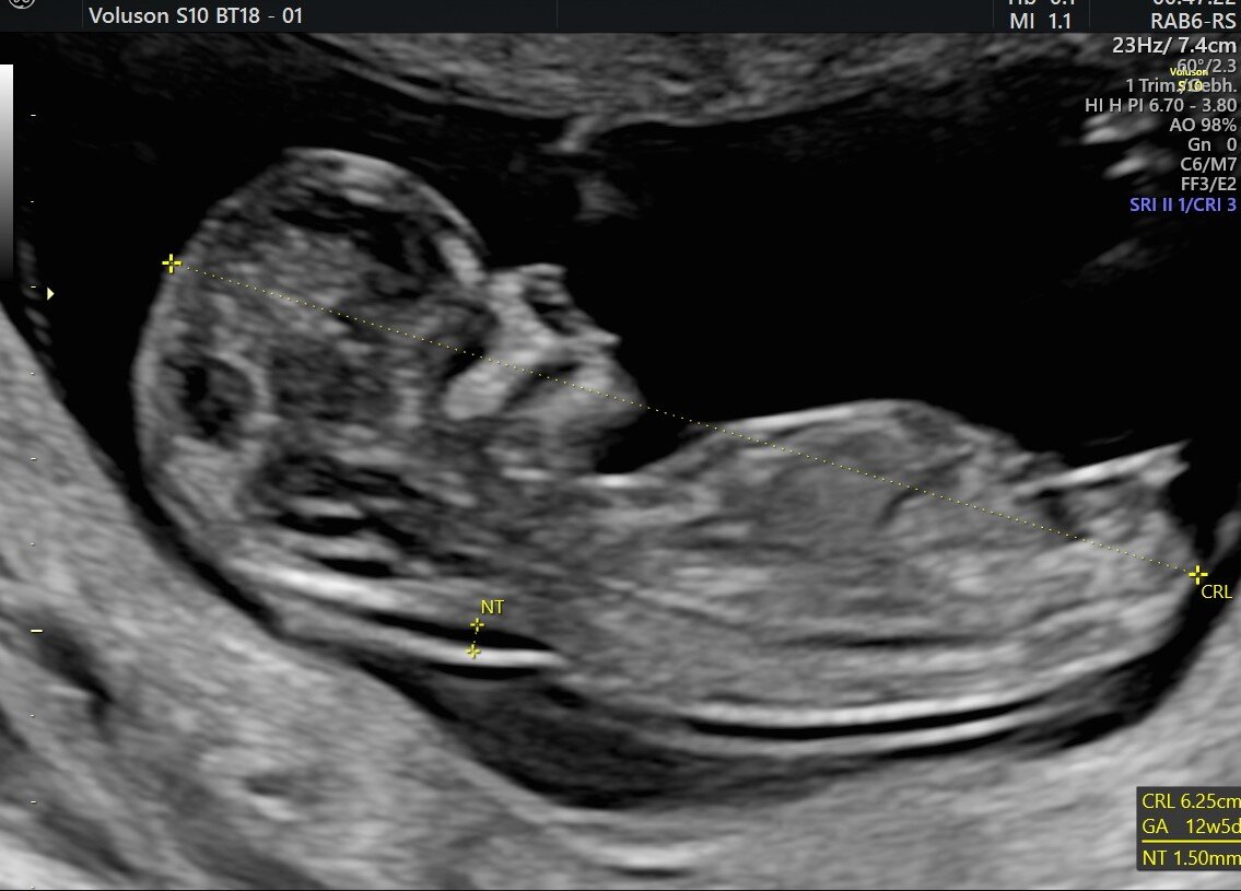 Pregnancy Scans Galway Ultrasound Specialists