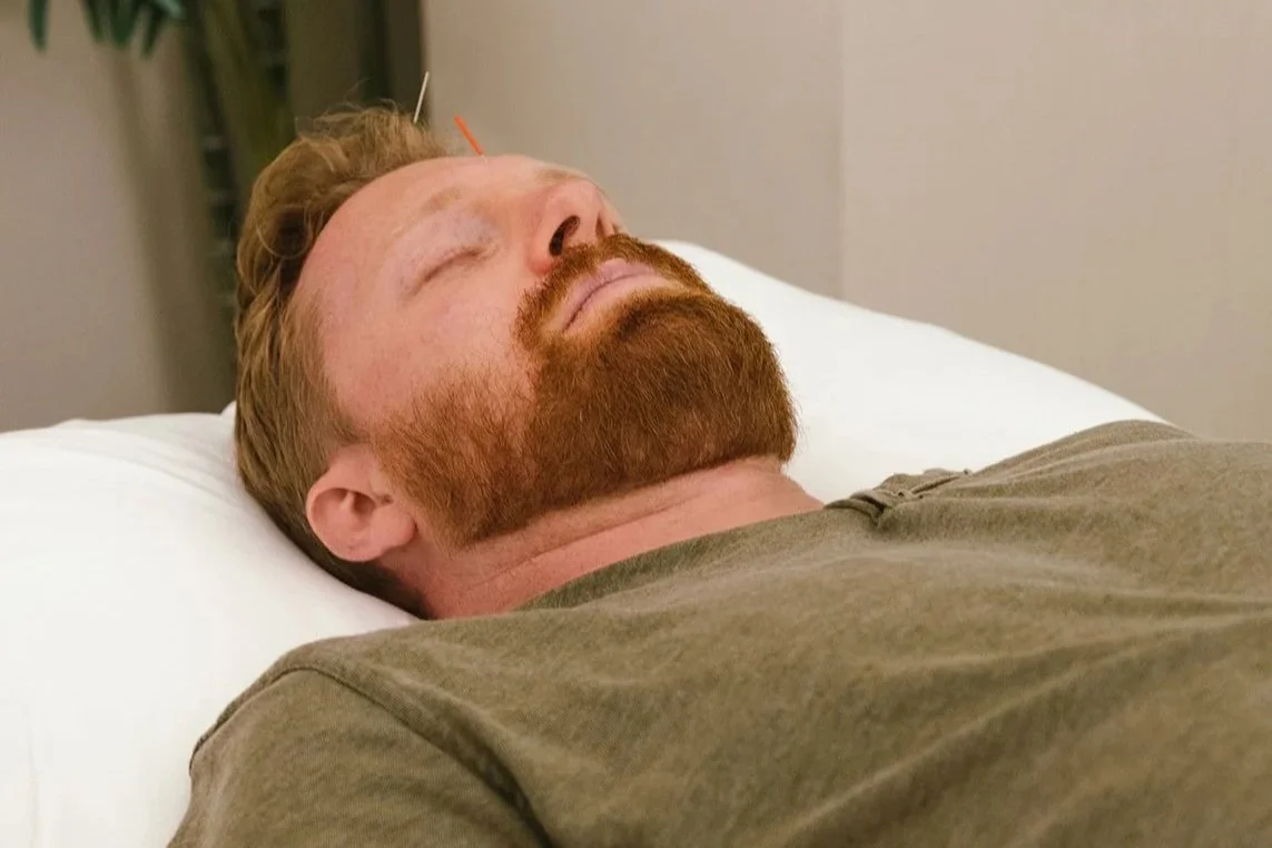 A man with red hair and a beard is resting on a massage table, with an acupuncture needle in his arm.