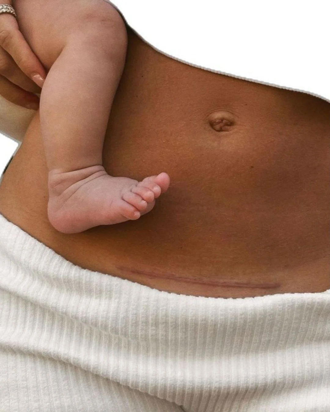 Your scar deserves care. 🤍
C-scar release with your osteopath softens tight tissue, restores sensation, and eases pulling through the pelvis and lower back.
From 8 weeks postpartum to 10+ years, it's never too late to support your c-section recovery