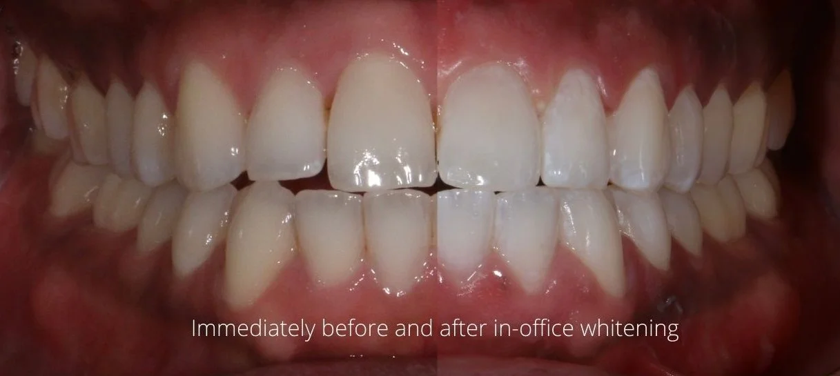 Immediately before and after in-office whitening_InPixio.jpg