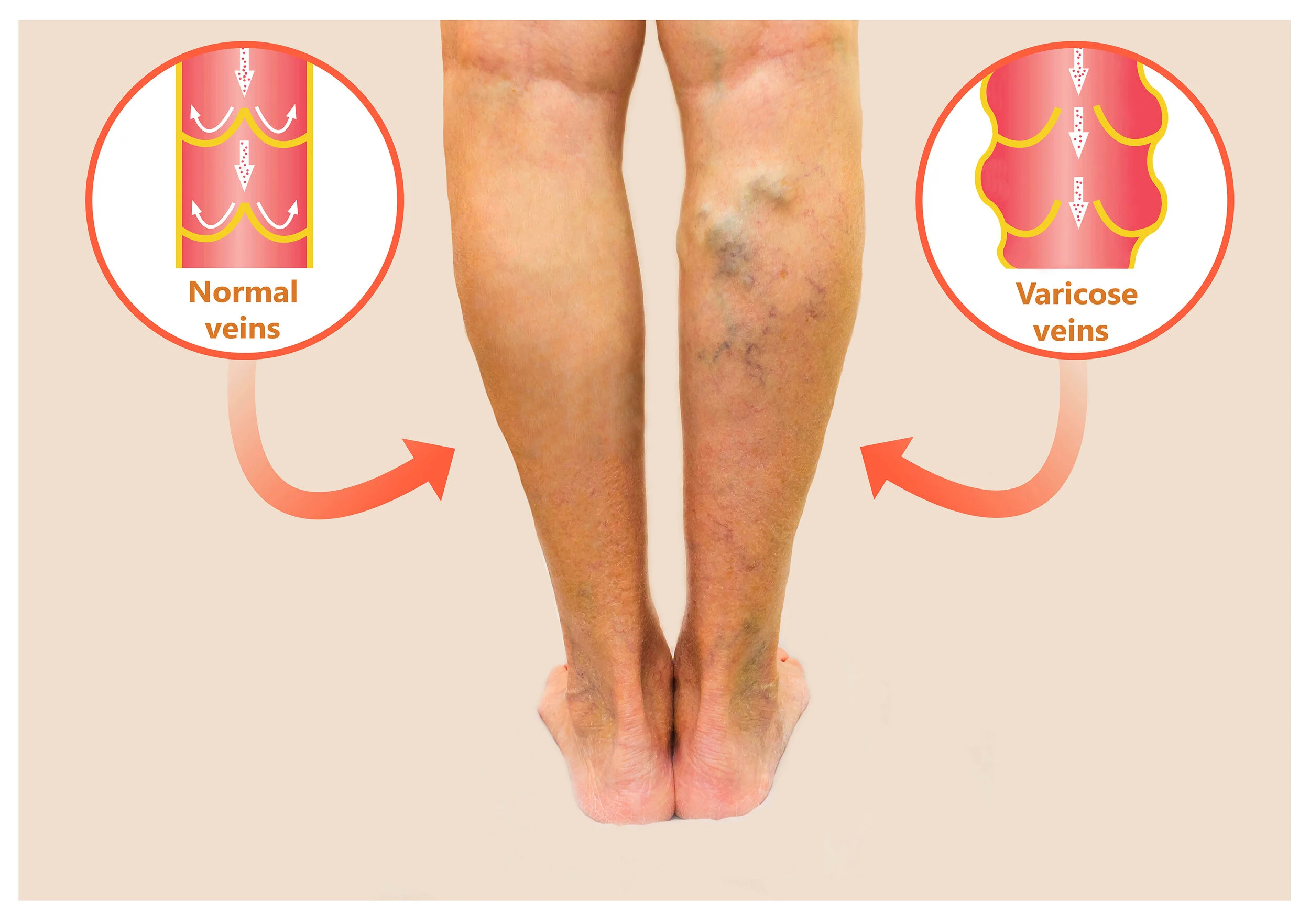 Vein Institute | How to get rid of Hemorrhoids