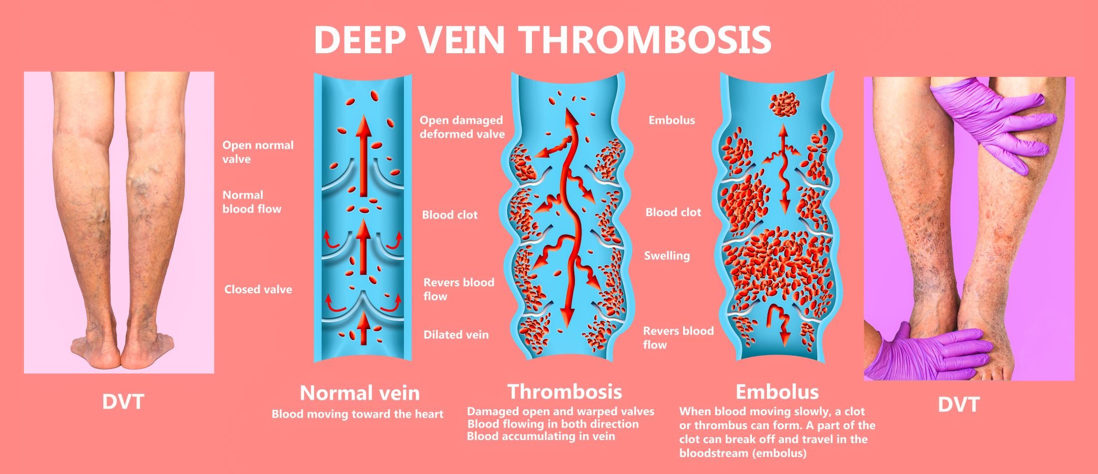 March is DVT Awareness Month