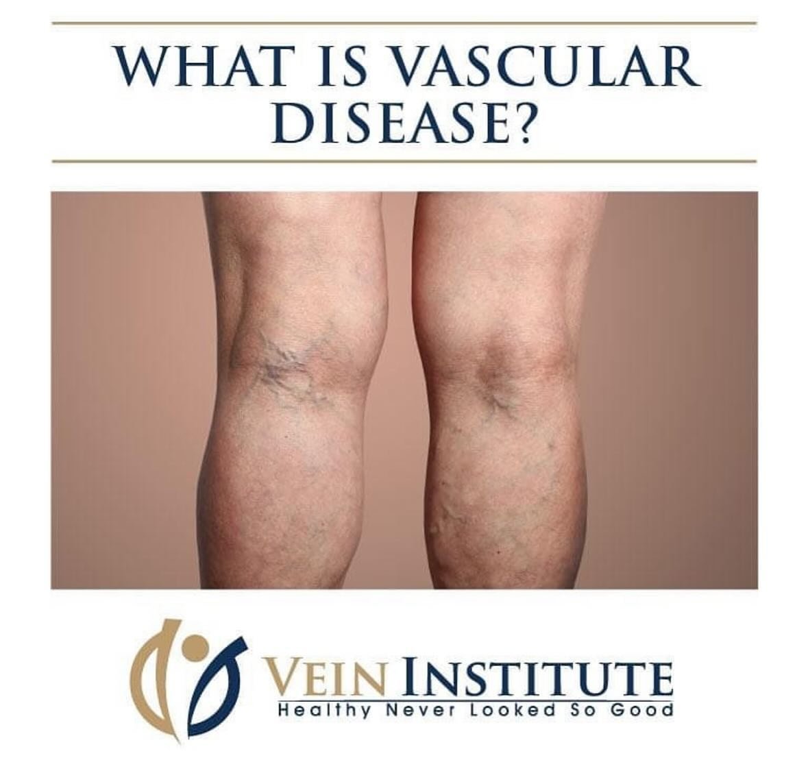 Vascular disease🩺 refers to any condition that affects your circulatory system - the vast network of arteries and veins in your body. Individuals of all ages, genders and races are at risk for developing vascular diseases but certain risk factors ca