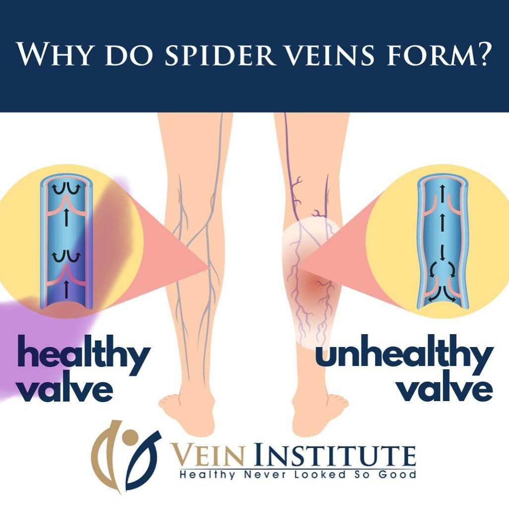 Have you ever wondered why spider veins appear on your legs? The culprit is often weakened valves in the veins, causing blood to pool and form those delicate, web-like patterns.🕷 

➡️ To learn more about spider veins and how to prevent them check ou
