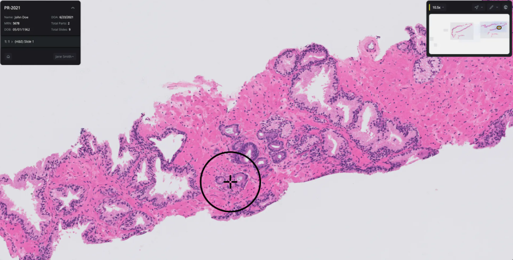 PaigeProstate: FDA authorized the first AI-based software that can help identify prostate cancer