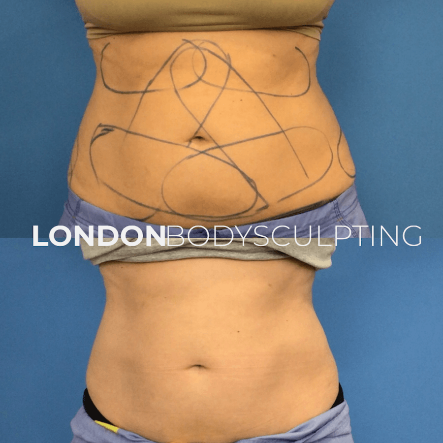 Elite-Abdomen_10.3.PNG