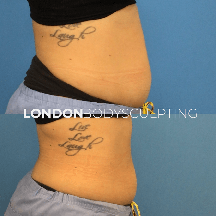Coolsculpting Elite 18