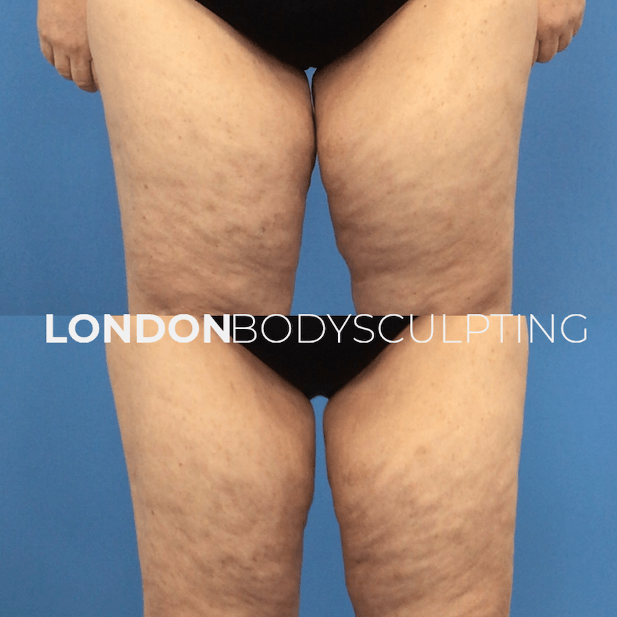 Elite-Inner Thigh_1.PNG