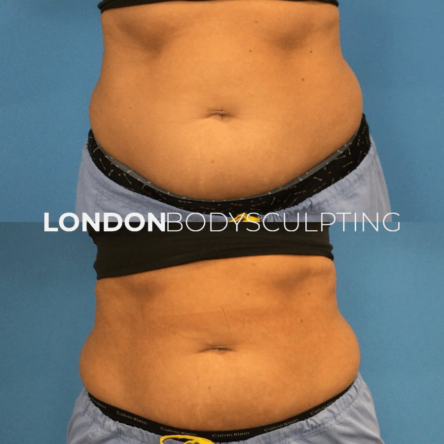 Elite-Abdomen_3.4.PNG