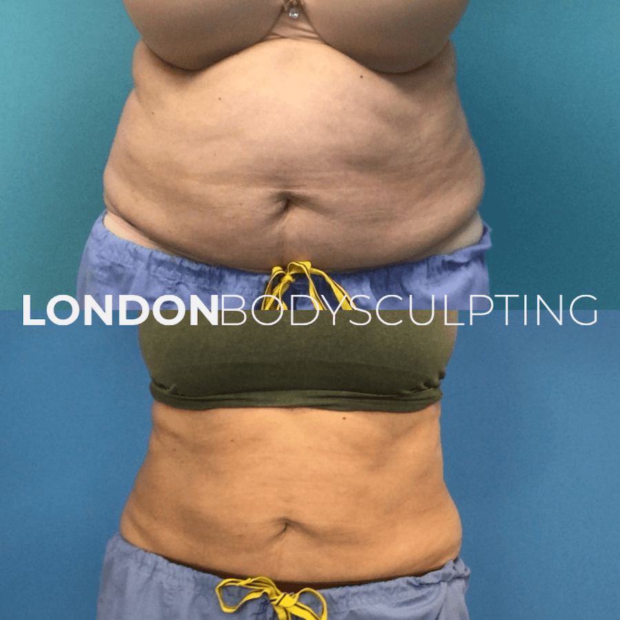 Elite-Abdomen_8.1.PNG