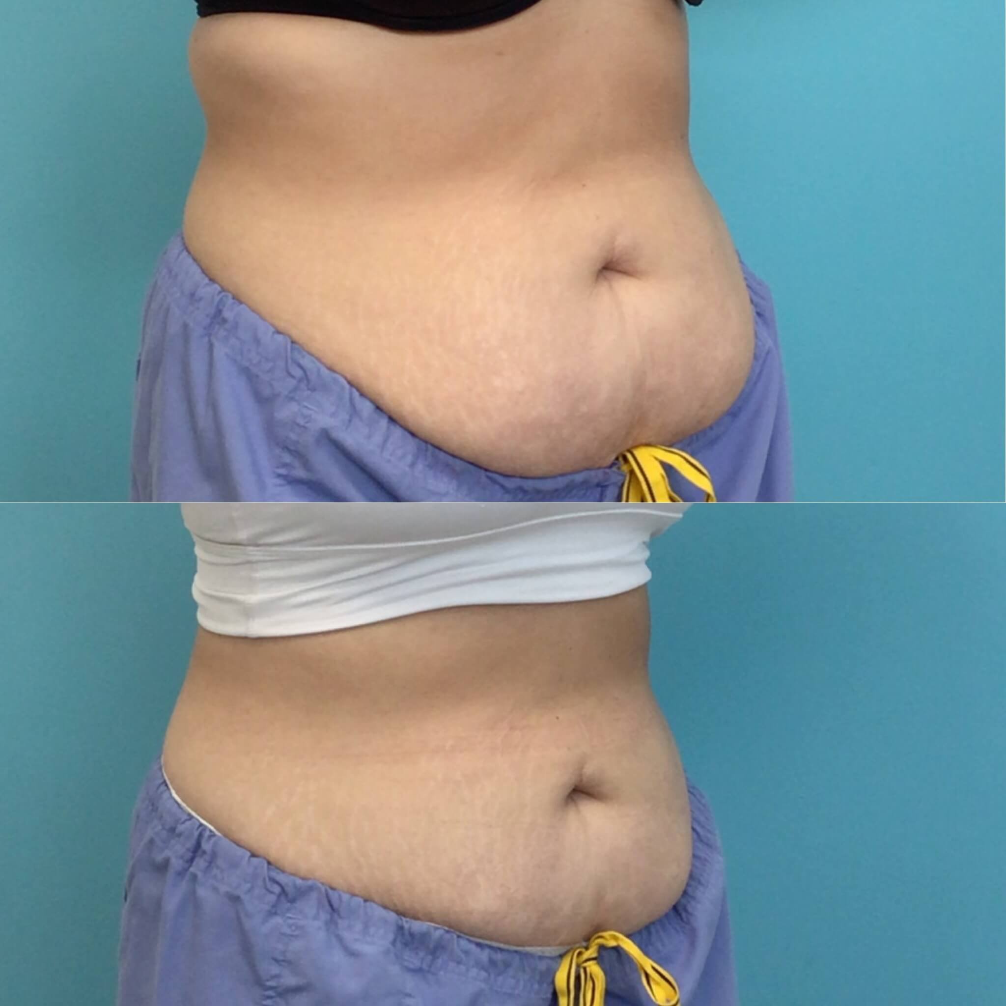Abdomen 69_1.JPG