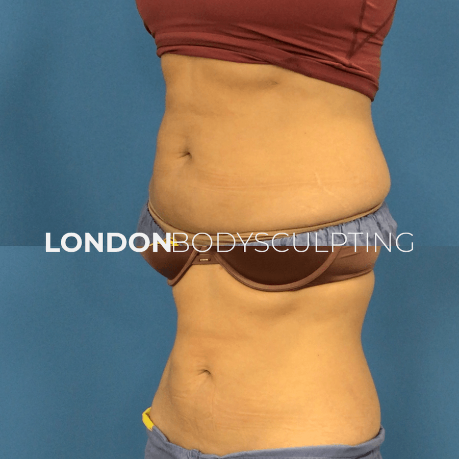 Elite-Abdomen_2.1.PNG
