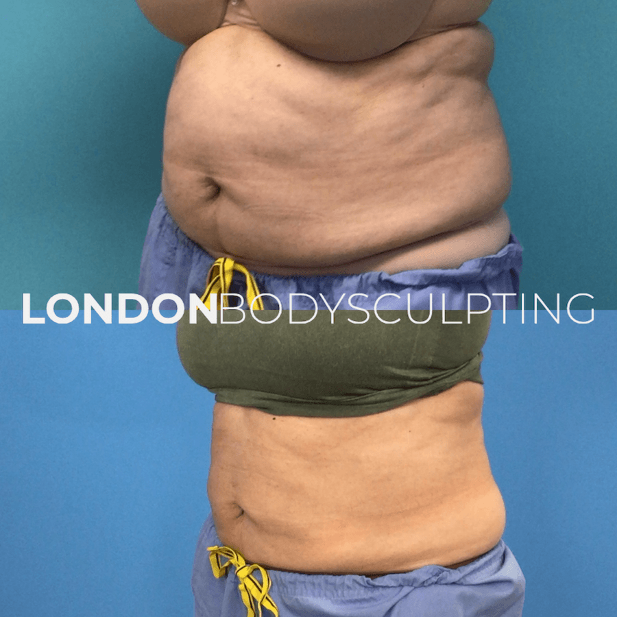 Elite-Abdomen_8.2.PNG
