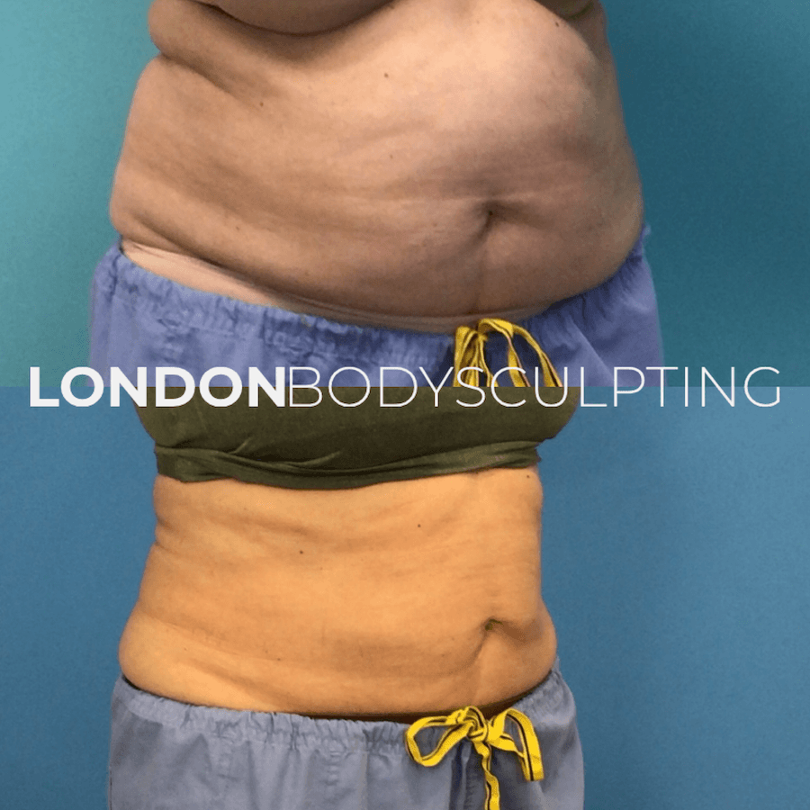 Elite-Abdomen_8.5.PNG