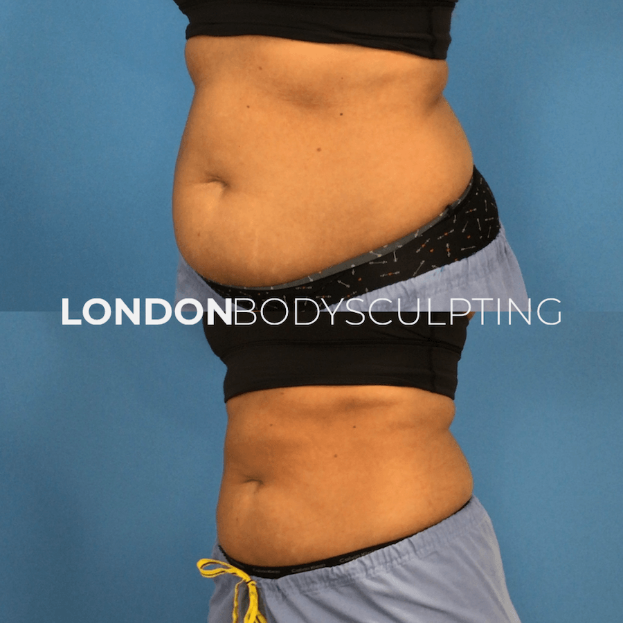 Coolsculpting Elite 16