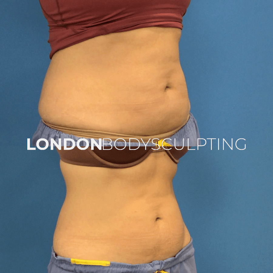 Elite-Abdomen_2.2.PNG