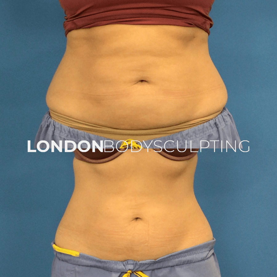 Elite-Abdomen_2.3.PNG