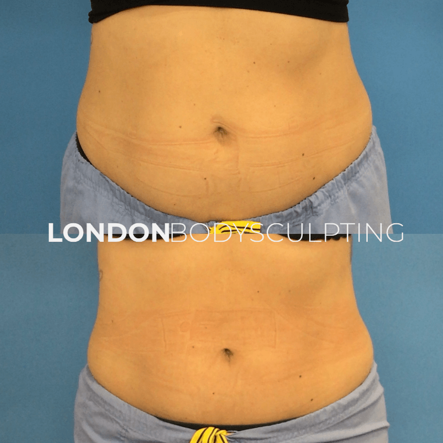 Elite-Abdomen_5.2.PNG