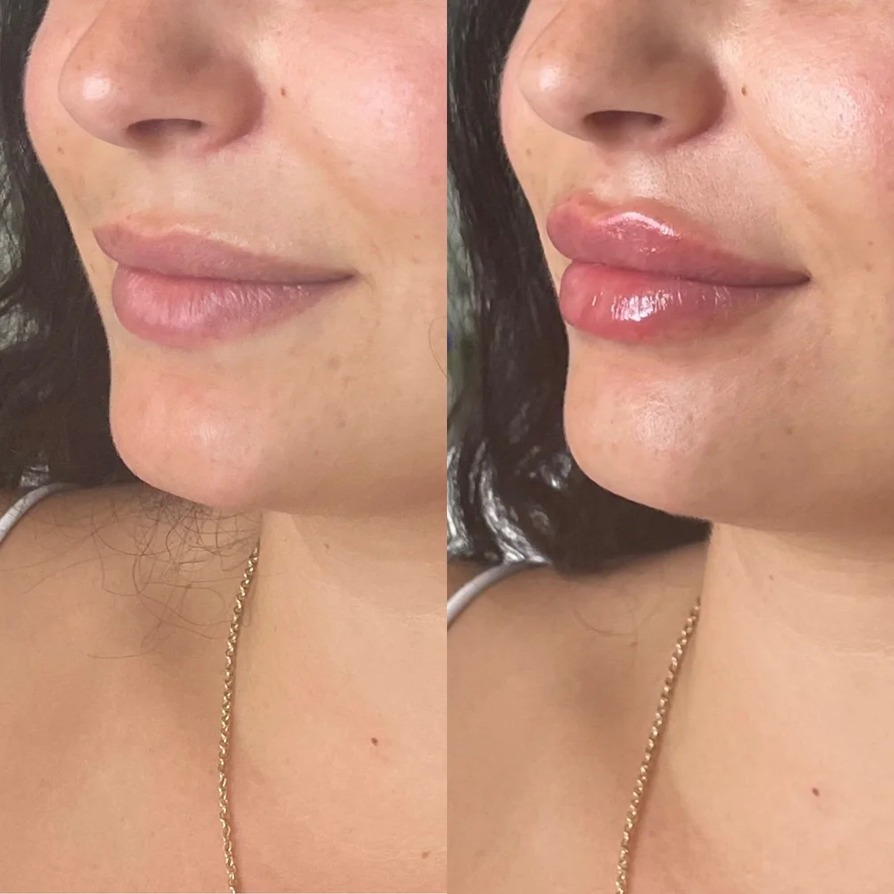 Best 0.5 Lip Filler Services in Ottawa &mdash; NURSE INJECTOR SHAY