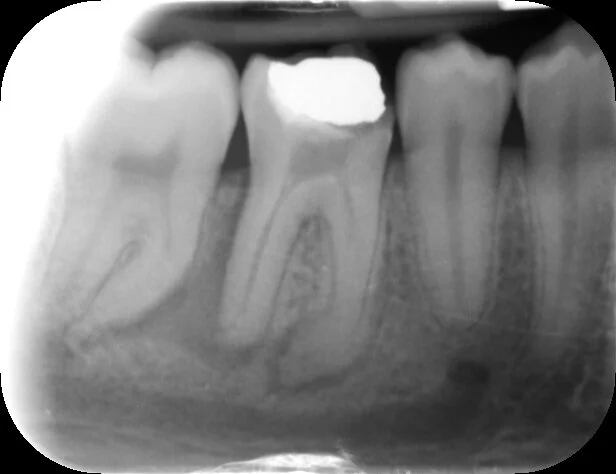 Pre-op PA of the LR6 shows a mesial cavity opening into the pulp, the mesial canals seem sclerosed towards the apex, this is further complicated by an acute curvature
