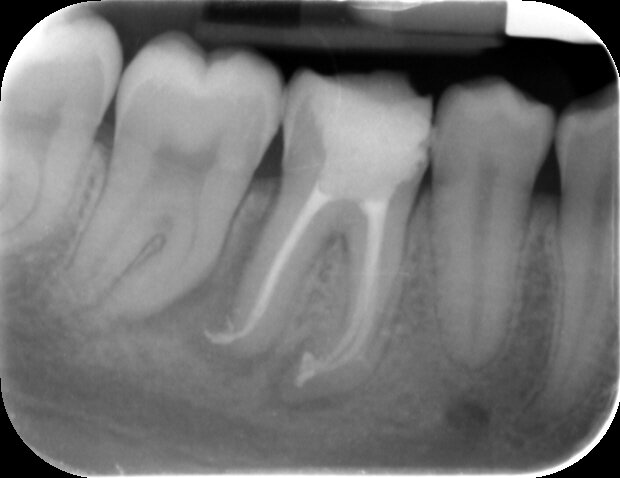 Post-op PA shows all canals well prepared to the apex