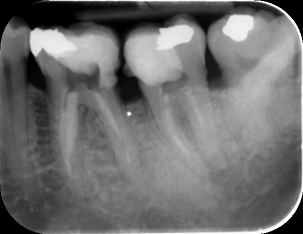 After removal of the separated instrument and full preparation of the canals an X-ray was taken and showed part of the file managed to enter the distal canal