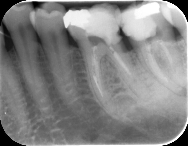 A separated file can be seen in one of the mesial canals (turned out to be the mesio-lingual canal), luckily it was visible with the use of high magnification and illumination