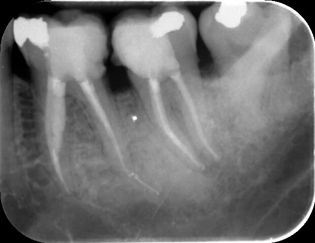 The last piece of the separated instrument was removed and all canals were filled with a good apical-coronal seal
