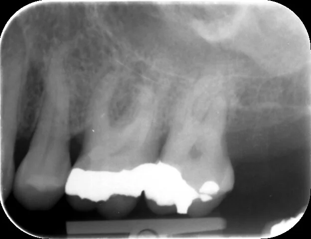 An apical radiolucency on the UL6 is one of the signs of apical periodontitis for this tooth