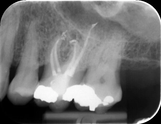 All four canals have well condensed root fillings with good apical-coronal seals