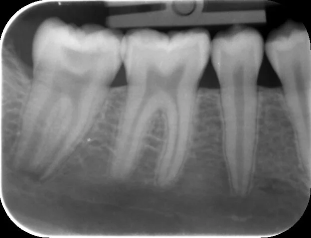 An occlusal carious lesion breaching the pulp horn of the second molar, the apices are not fully developed