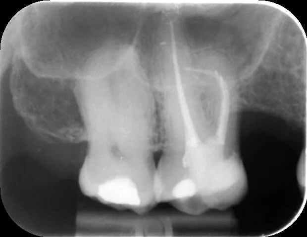 The fully obturated canals reveal the true nature of that extreme curvature in the mesio-buccal canal