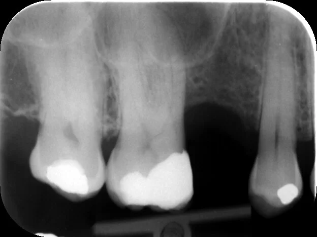 The angle of this PA hid the true nature of the canal curvature