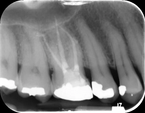 Post treatment with all canals filled with a good coronal-apical seal