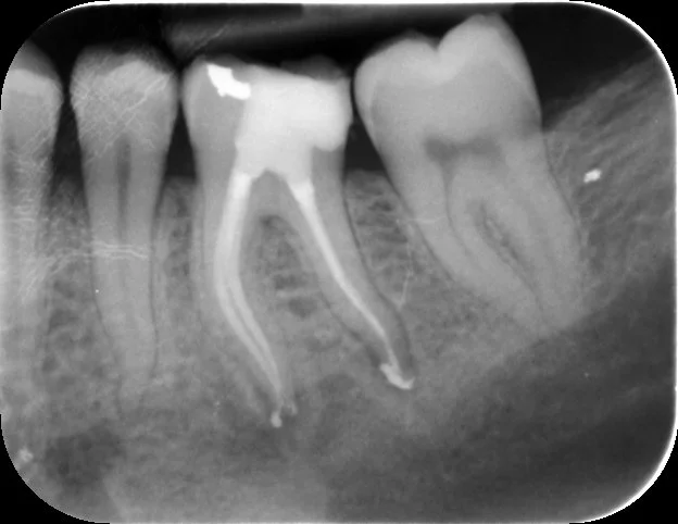 Post-op PA showing a good coronal-apical seal of all canals.