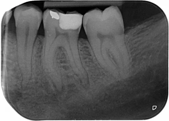 Pre-op PA of LL6 showing a deep DO restoration with secondary caries and apical radiolucencies.