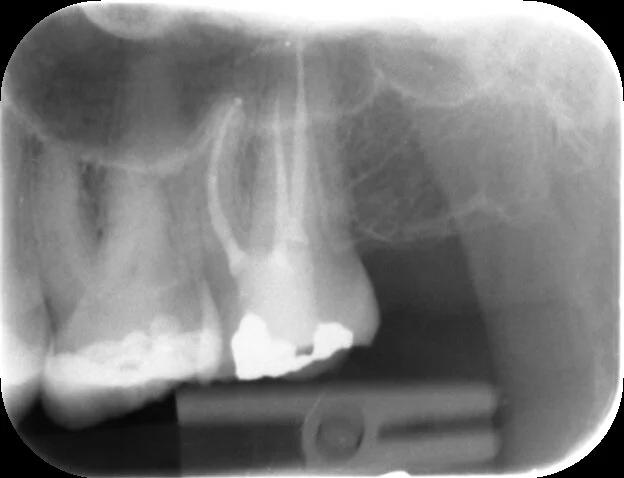 All canals are well obturated to length with a good apical-coronal seal